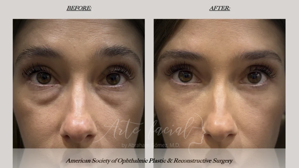 Bags before and after