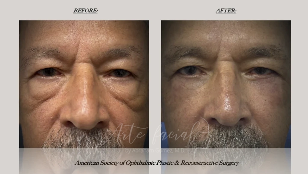 Before and after festoons surgery