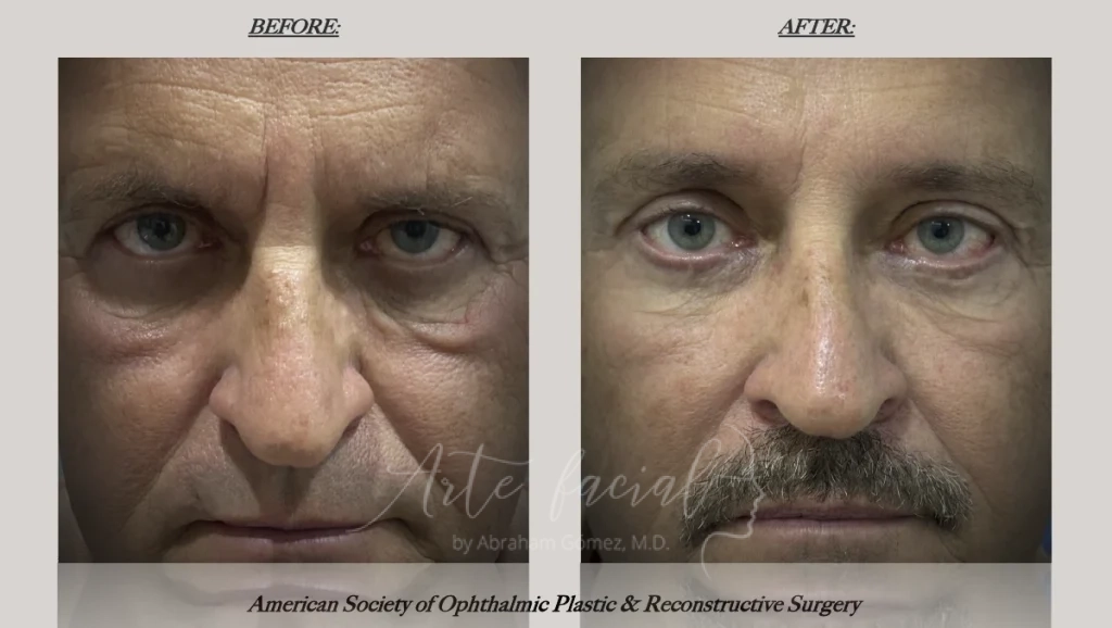 Brow lift men