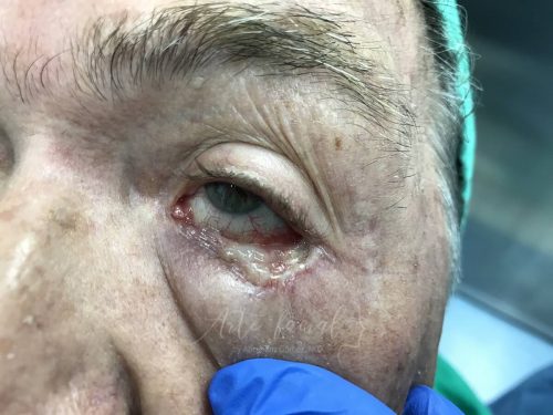 Basal Cell Carcinoma Eyelid