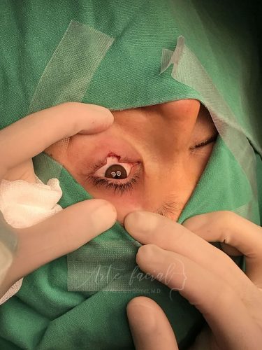 Pentagonal Wedge Eyelid - Resección con cuña