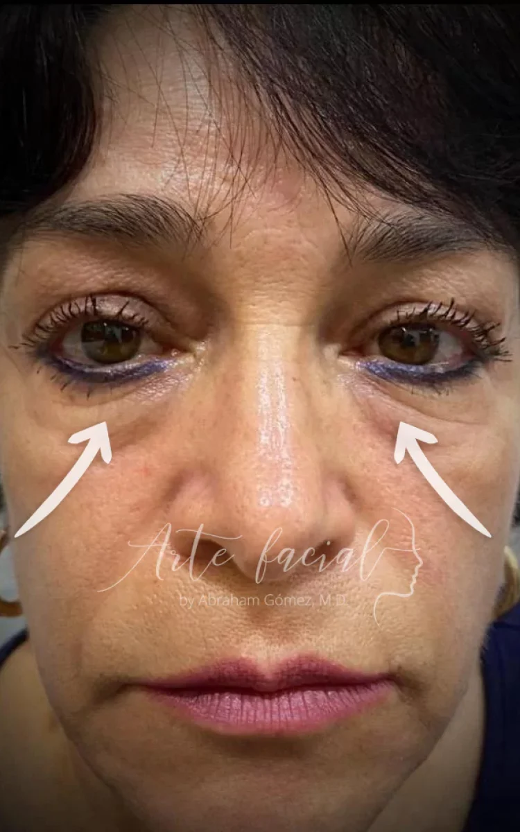 Arrugas debajo los ojos