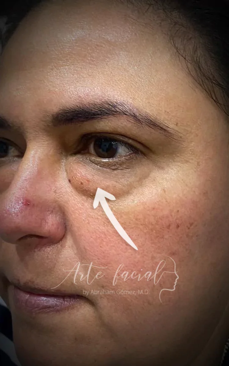 Bolsas debajo los ojos