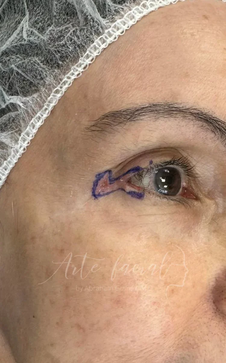 Carcinoma del párpado y canto lateral