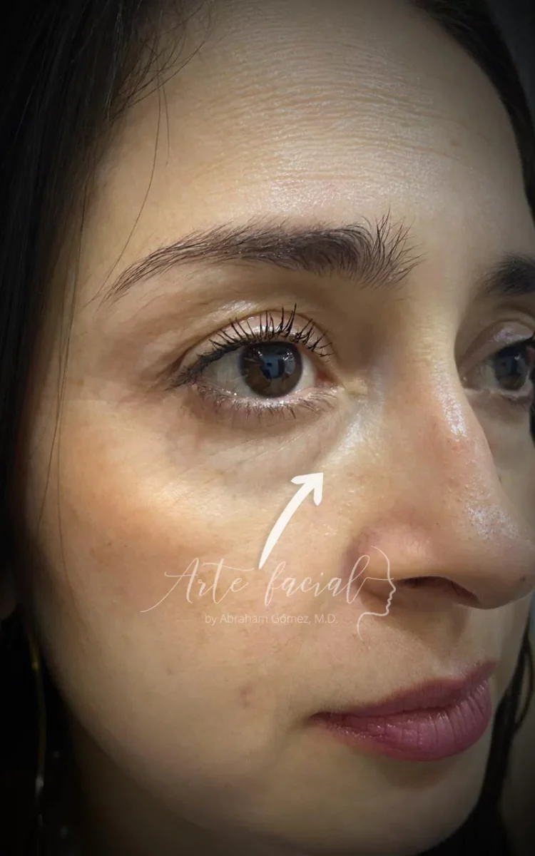 Concavidad en el párpado (surco lagrimal)