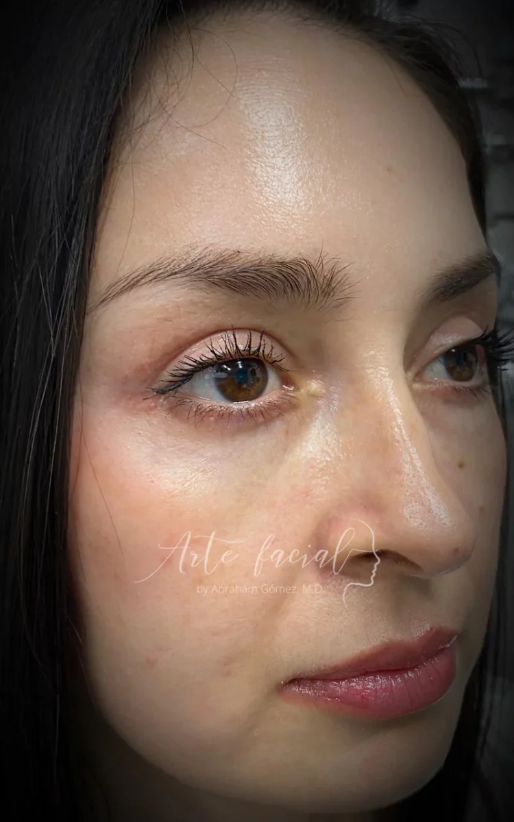 Corrección mediante transposición de grasa