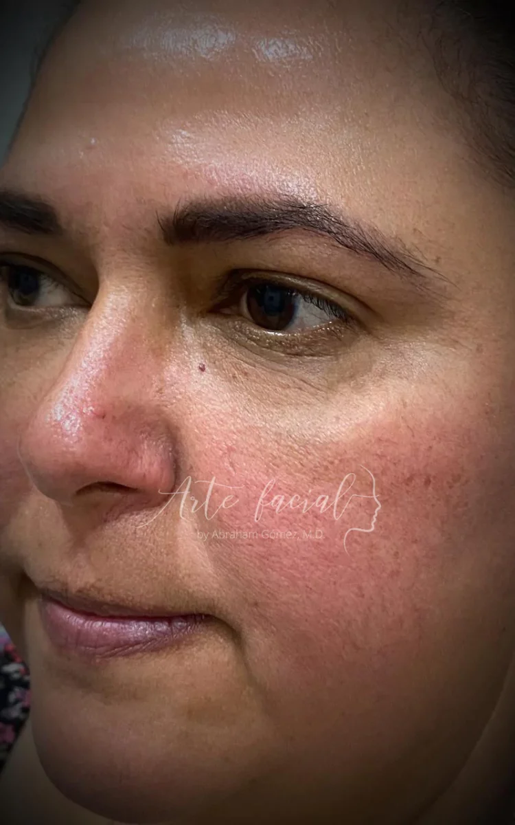 Después de la blefaroplastia