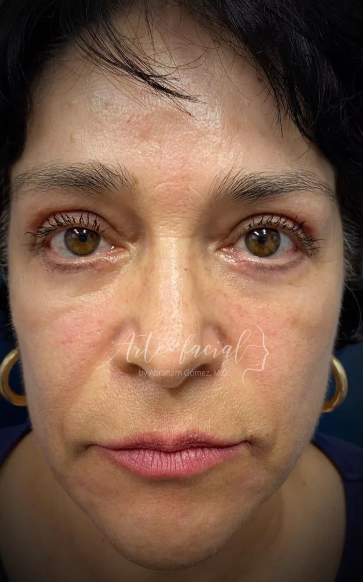 Después de la blefaroplastia inferior